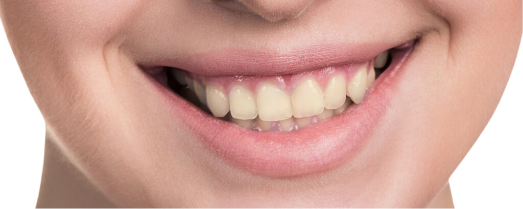 yellow teeth smile